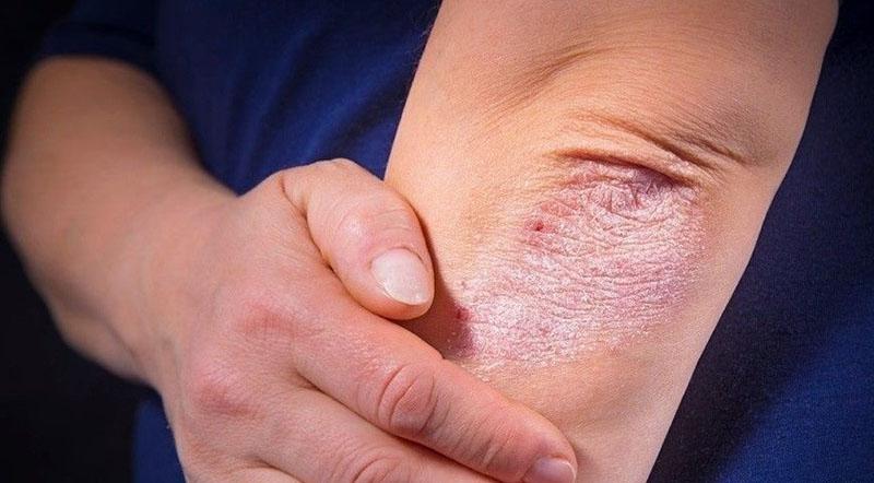 lutte contre le psoriasis