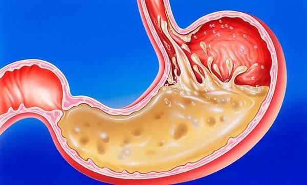 augmentation de l'acidité de l'estomac